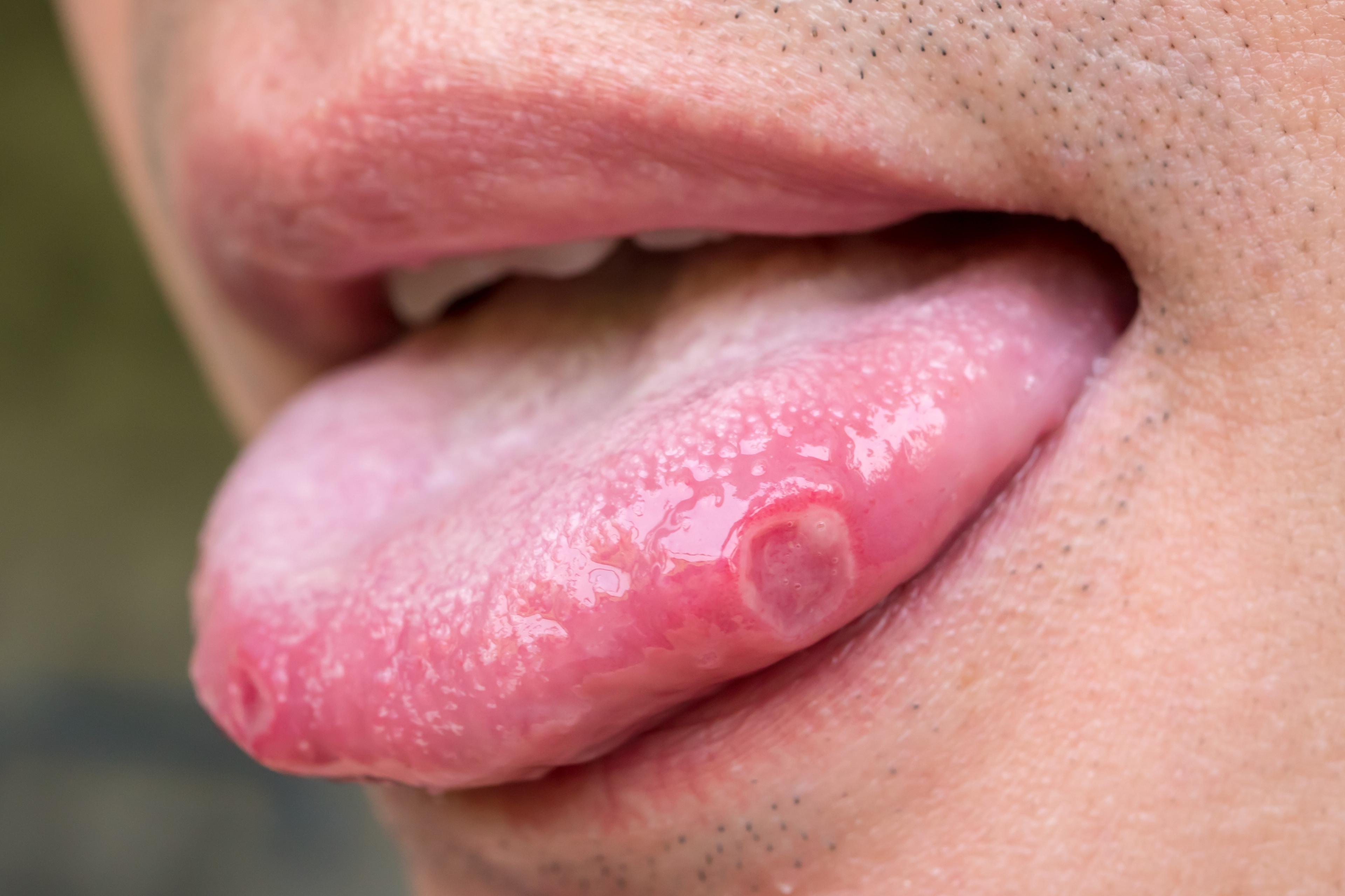 मुँह का अल्सर: प्रकार, कारण, लक्षण और निदान