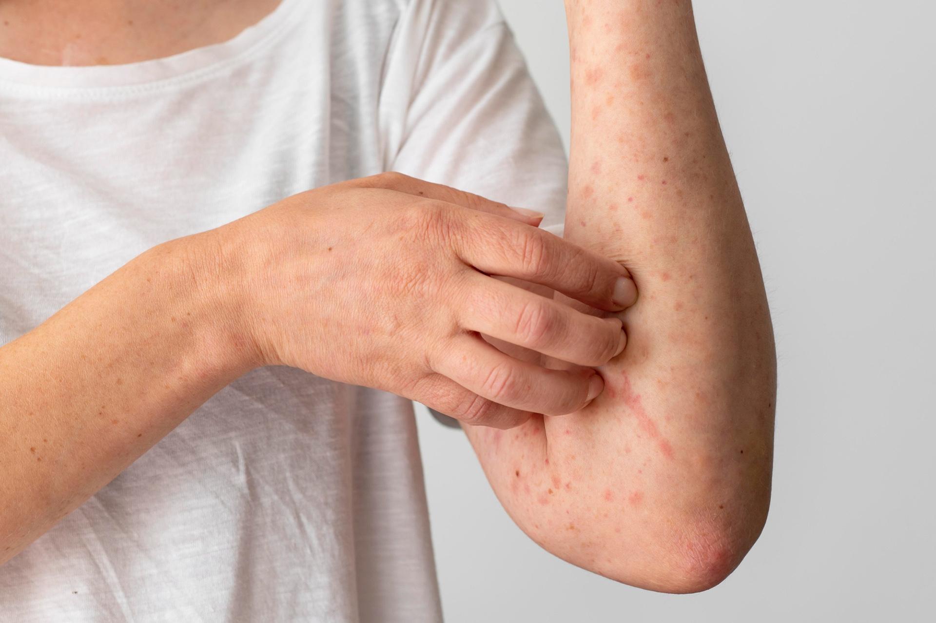 एक्जिमा त्वचा का भड़कना: एक्जिमा के लक्षण और इसकी रोकथाम