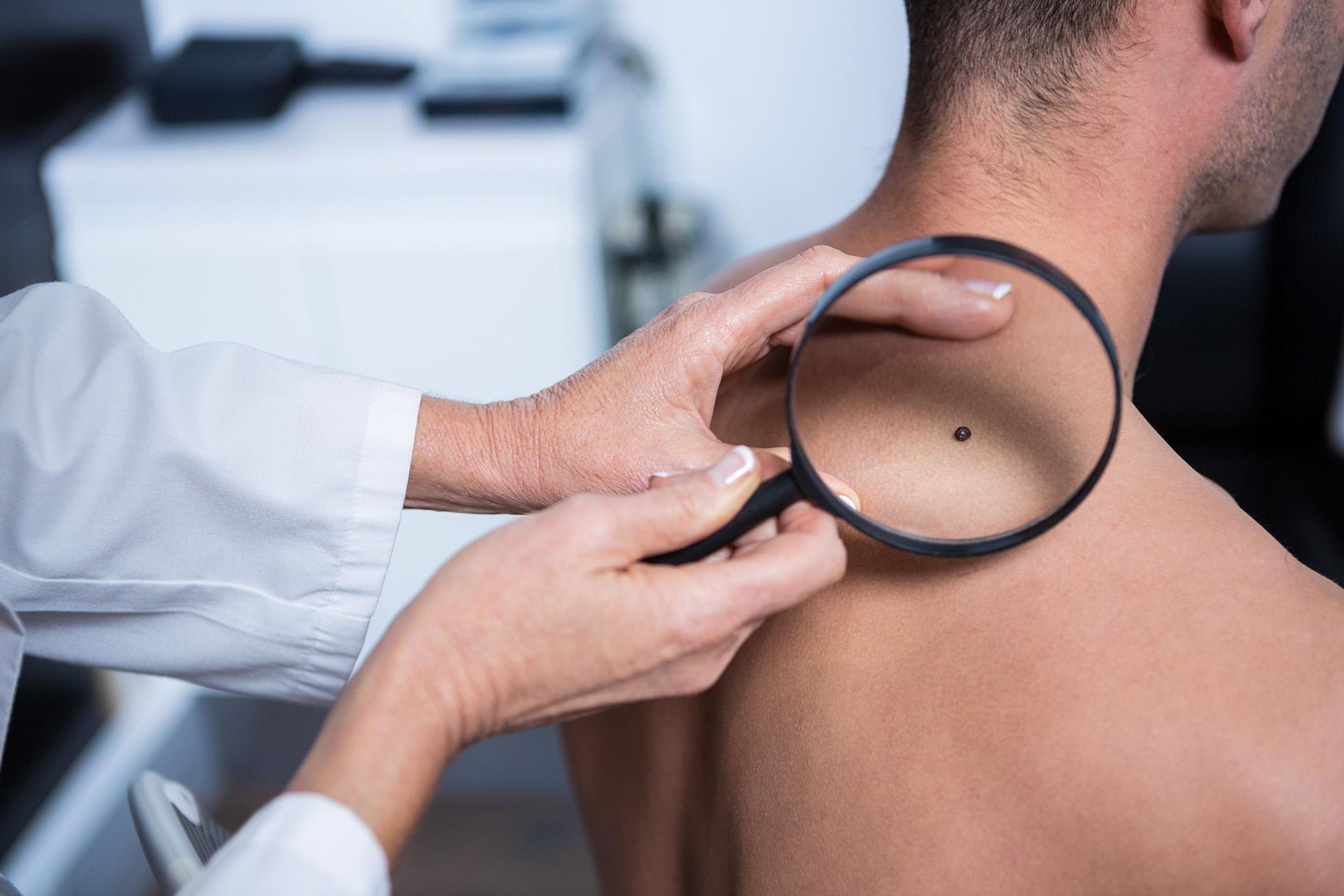 त्वचा पर तिल का उपचार, प्रकार और निदान: तिल हटाने के विकल्प