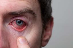 डोळ्यांच्या बुबुळाच्या पुढील भागाचा होणारा दाह (गुलाबी डोळे): कारणे, लक्षणे आणि प्रतिबंध