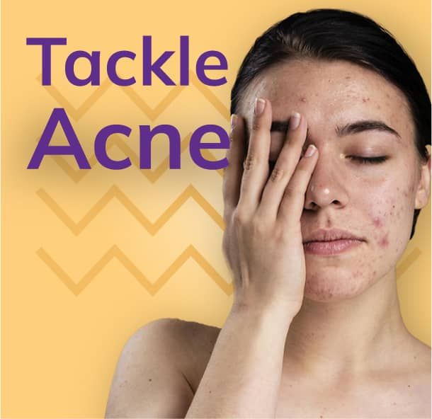 6 Homemade Acne Treatment Options