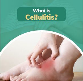 What is Cellulitis? | Causes, Symptoms, Diagnosis, and Treatment | Bajaj Finserv Health