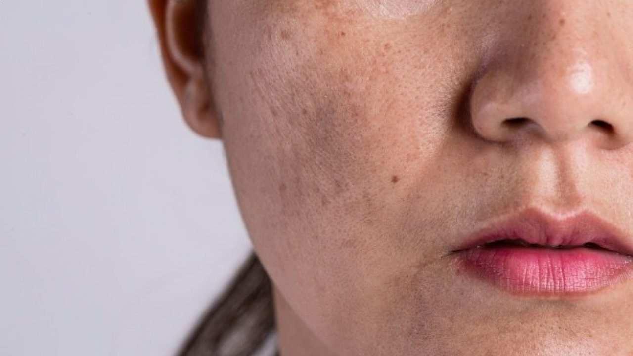 Hyperpigmentation: Symptoms, Causes, and Treatment