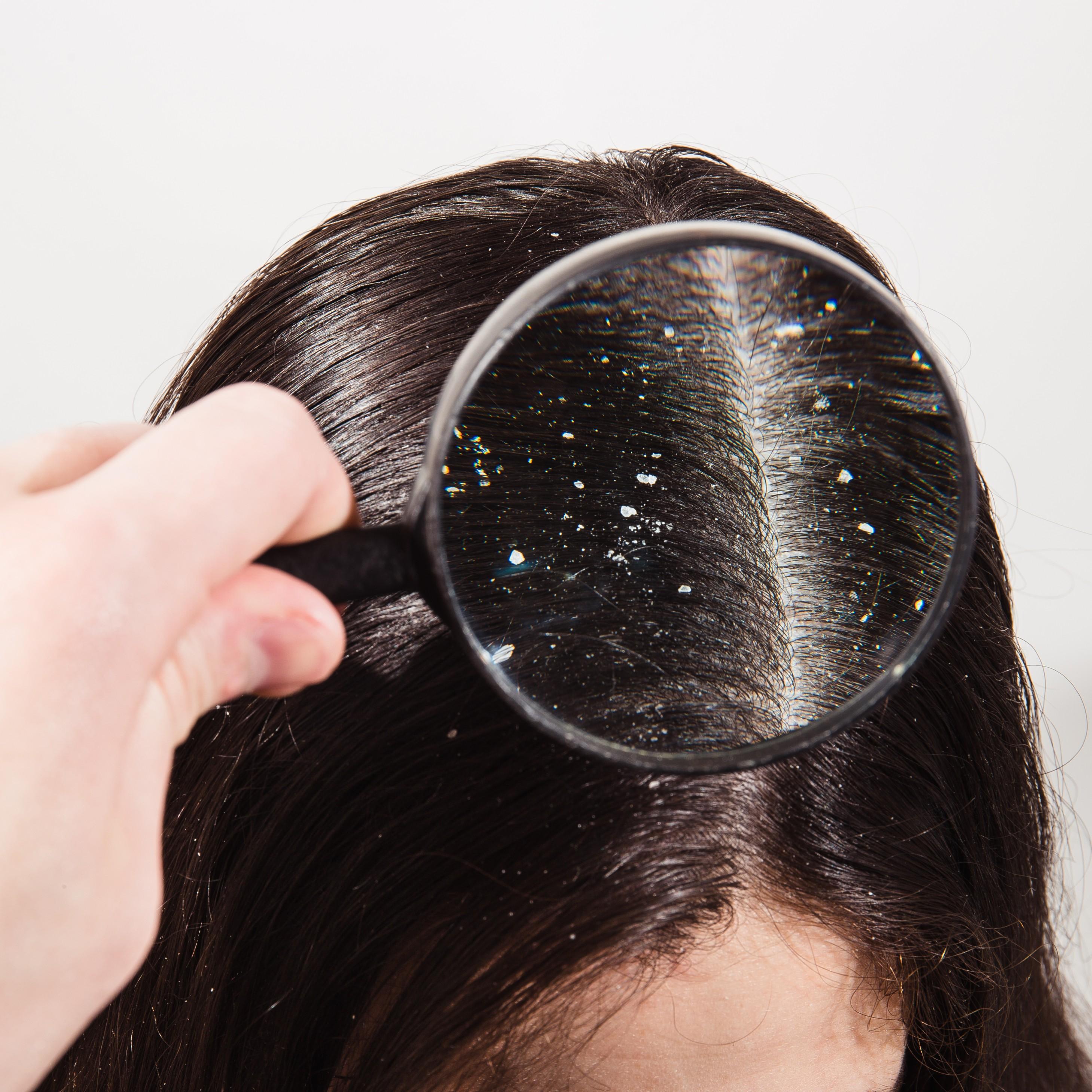 What Is Dandruff: Symptoms, Causes, Prevention, Remedies