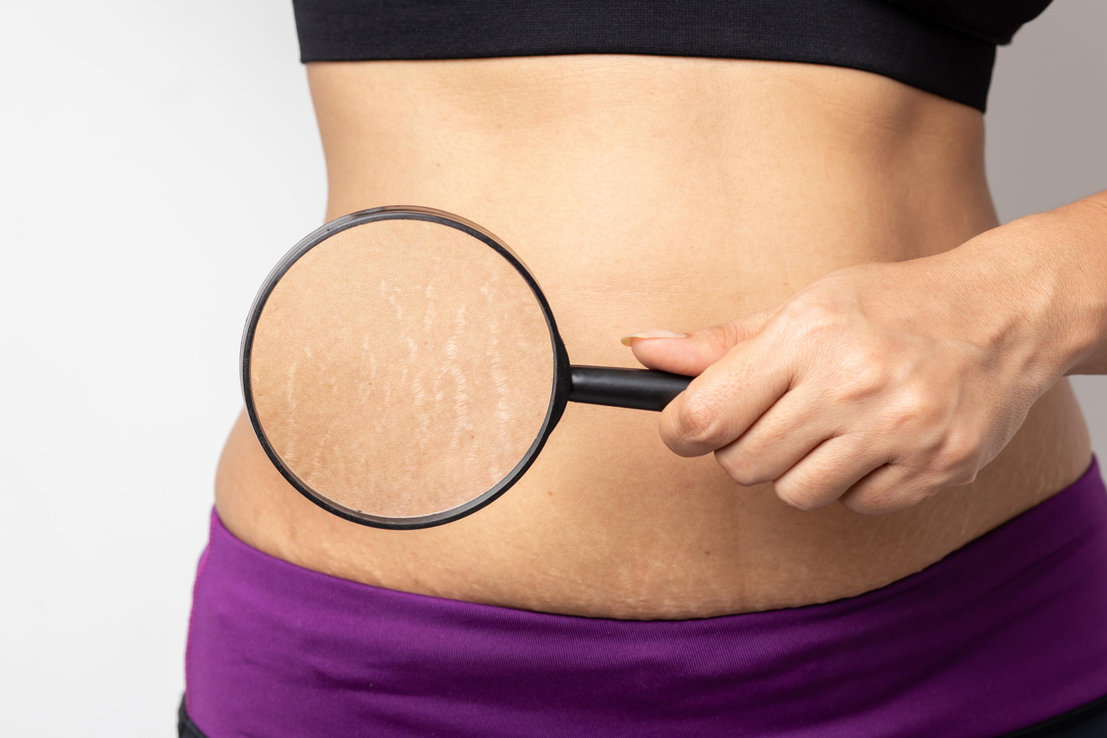 Stretch Marks: Signs, Complication, Treatment, Diagnosis