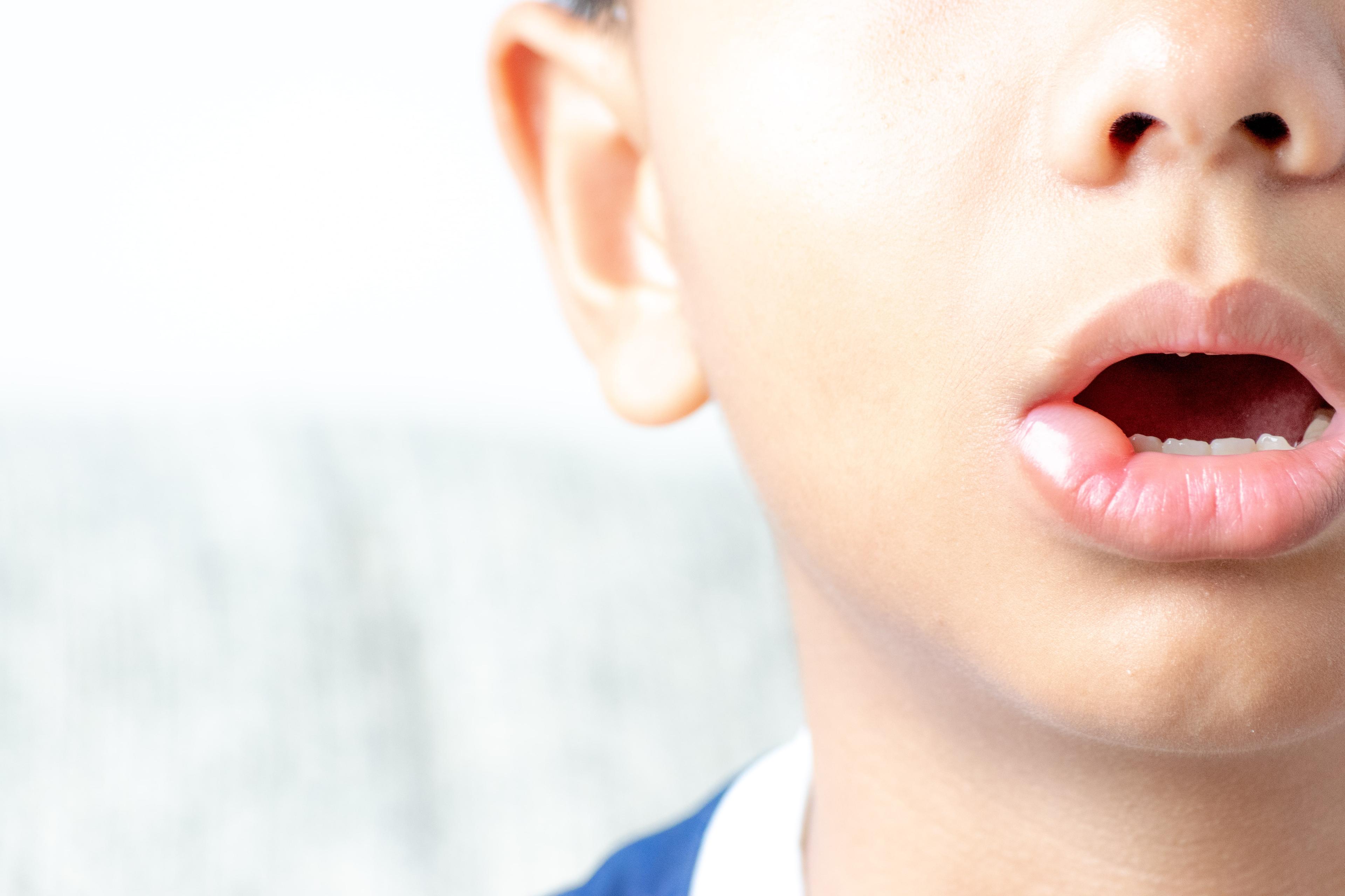 Cold Sore On Lips: Causes, Medications, Stages, Home Remedies