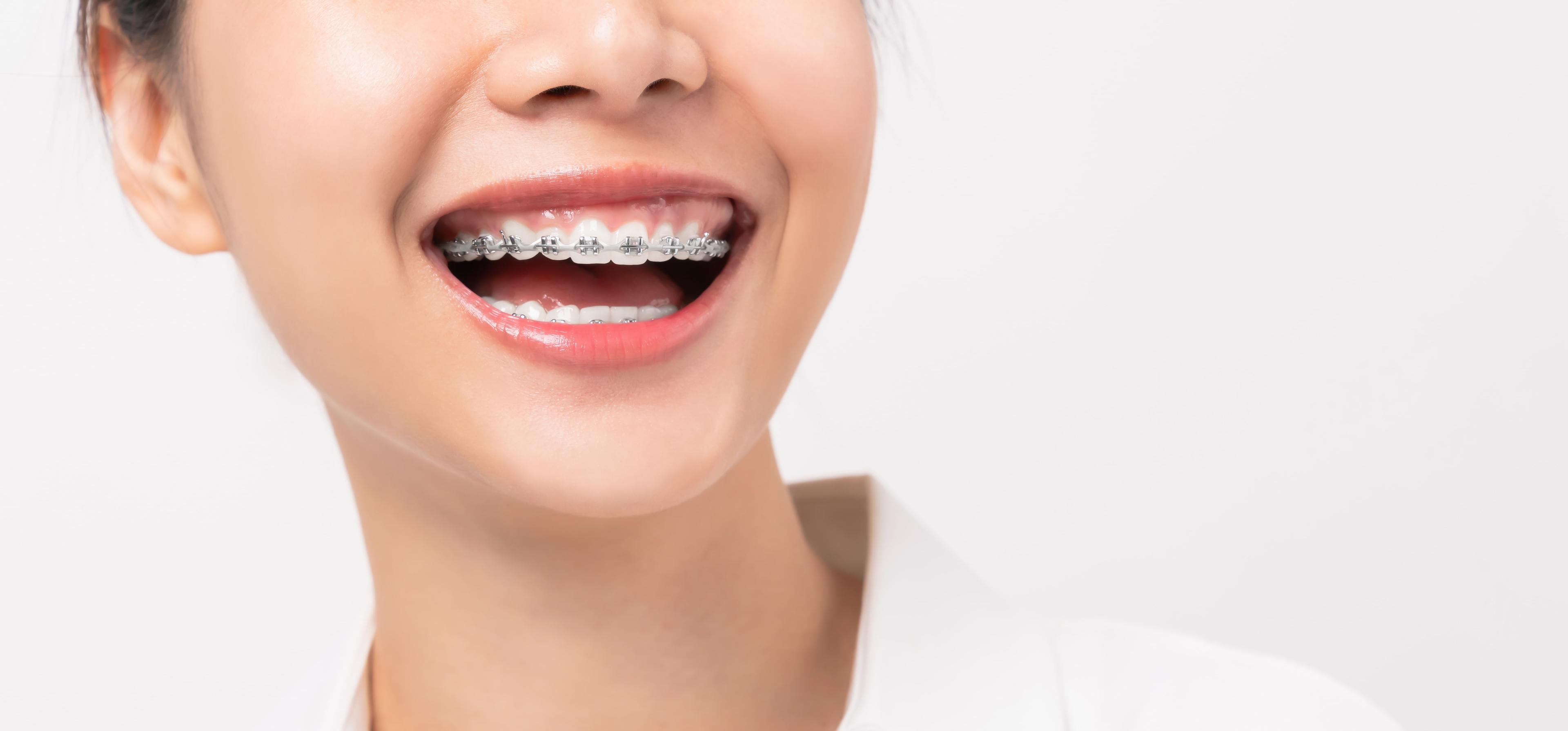 6 Tips To Make Wearing Braces More Comfortable