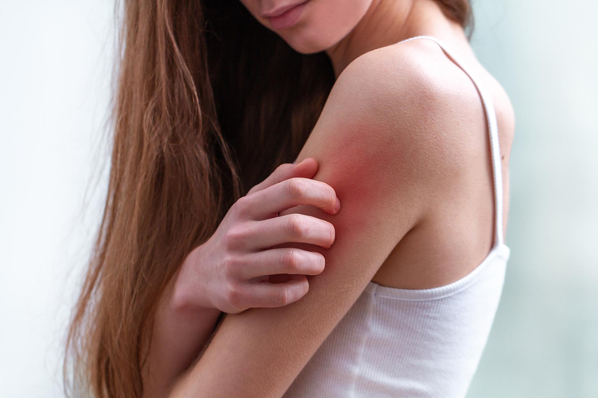 How to Protect Yourself From Different Types of Skin Rashes