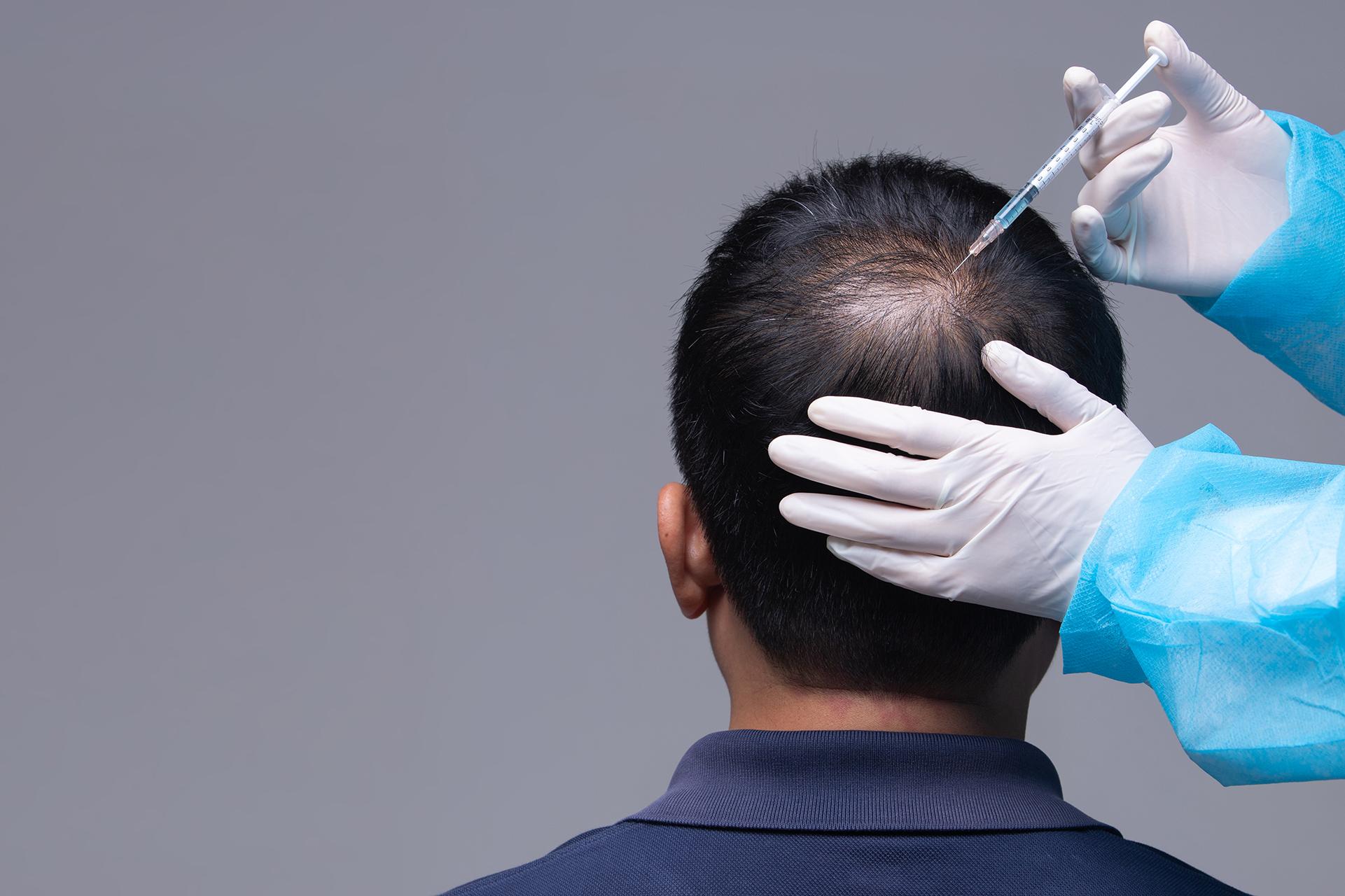What is Hair Transplant? All you Need to Know About This Popular Procedure