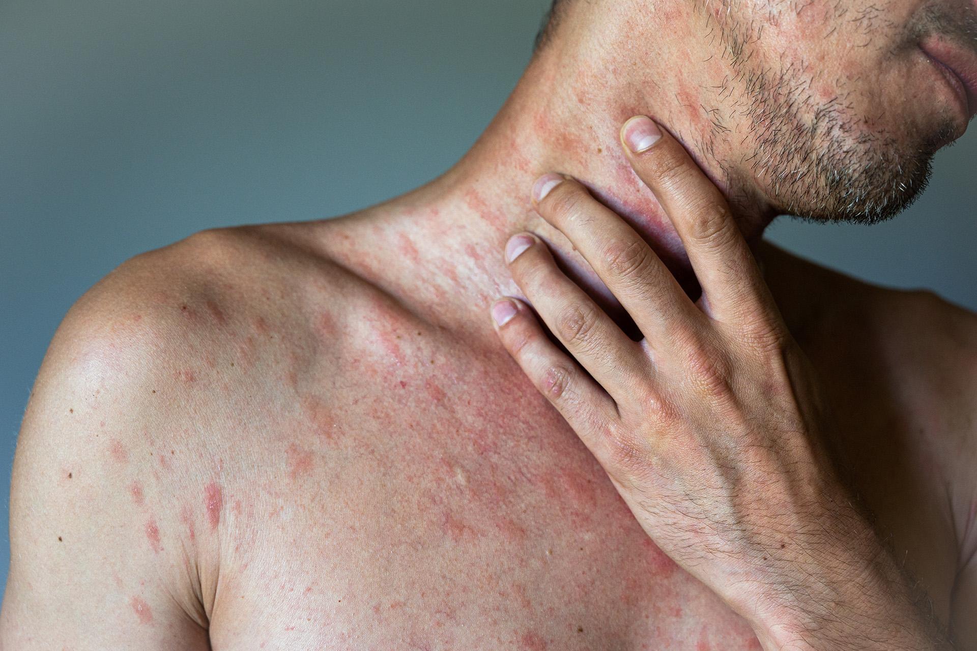 Hives On Skin: Symptoms, Causes, and Treatment