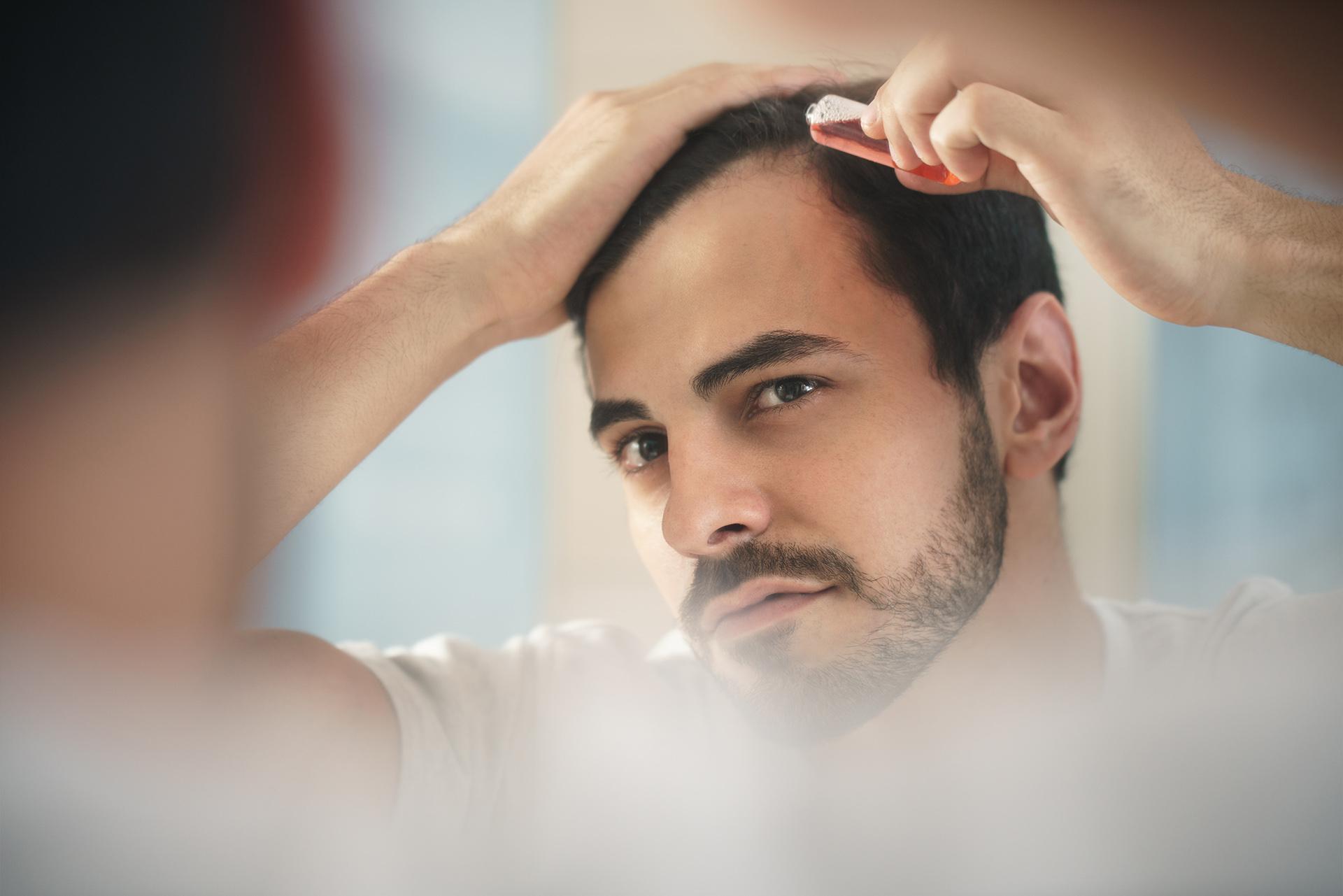 Alopecia Areata: Causes, Symptoms, Diagnosis And Treatment