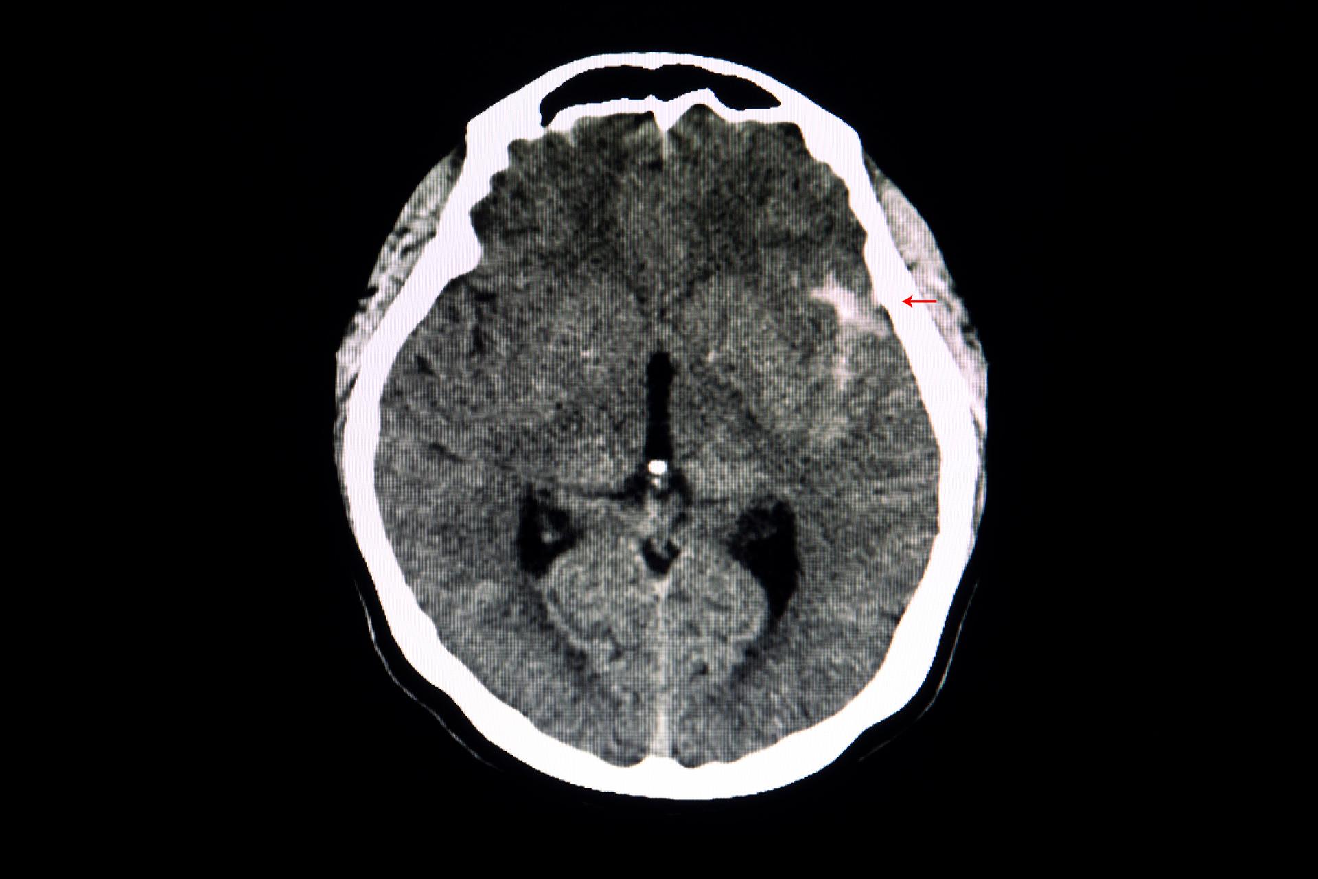 Brain Aneurysm: Causes, Complications, Diagnosis, Risk Factor