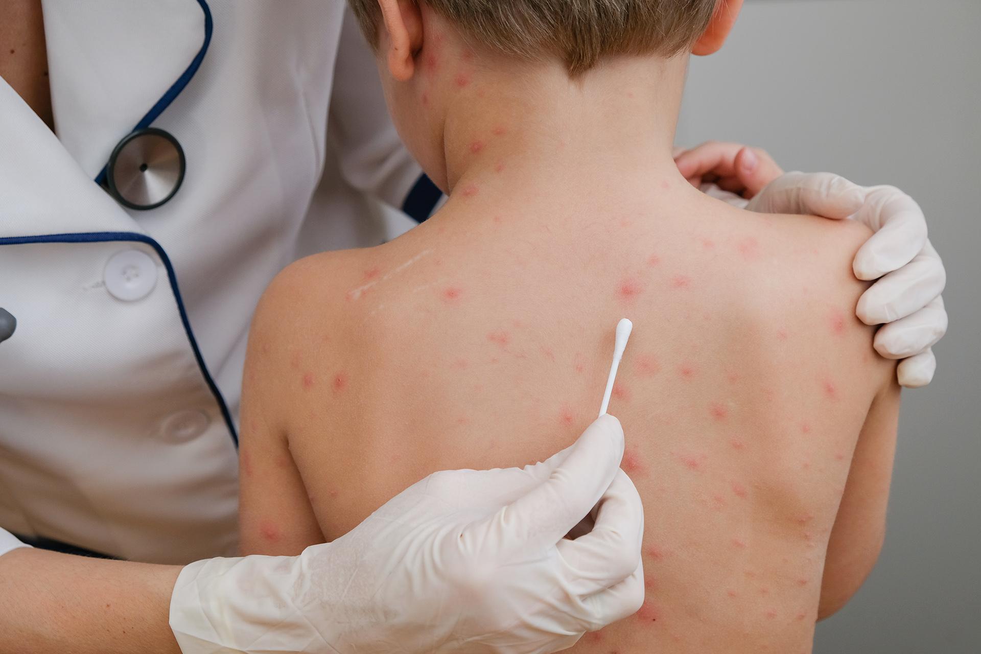 Chickenpox: Guide to its Causes, Treatment, and More!