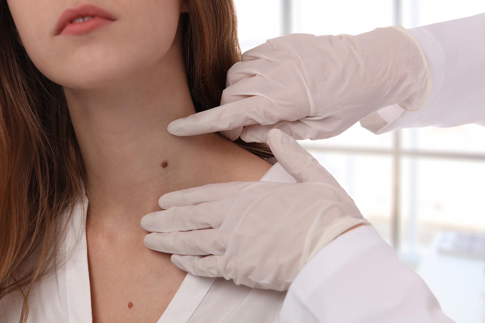 Thinking About Skin Tag Removal? Keep These 4 Points in Mind