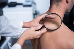 त्वचा पर तिल का उपचार, प्रकार और निदान: तिल हटाने के विकल्प