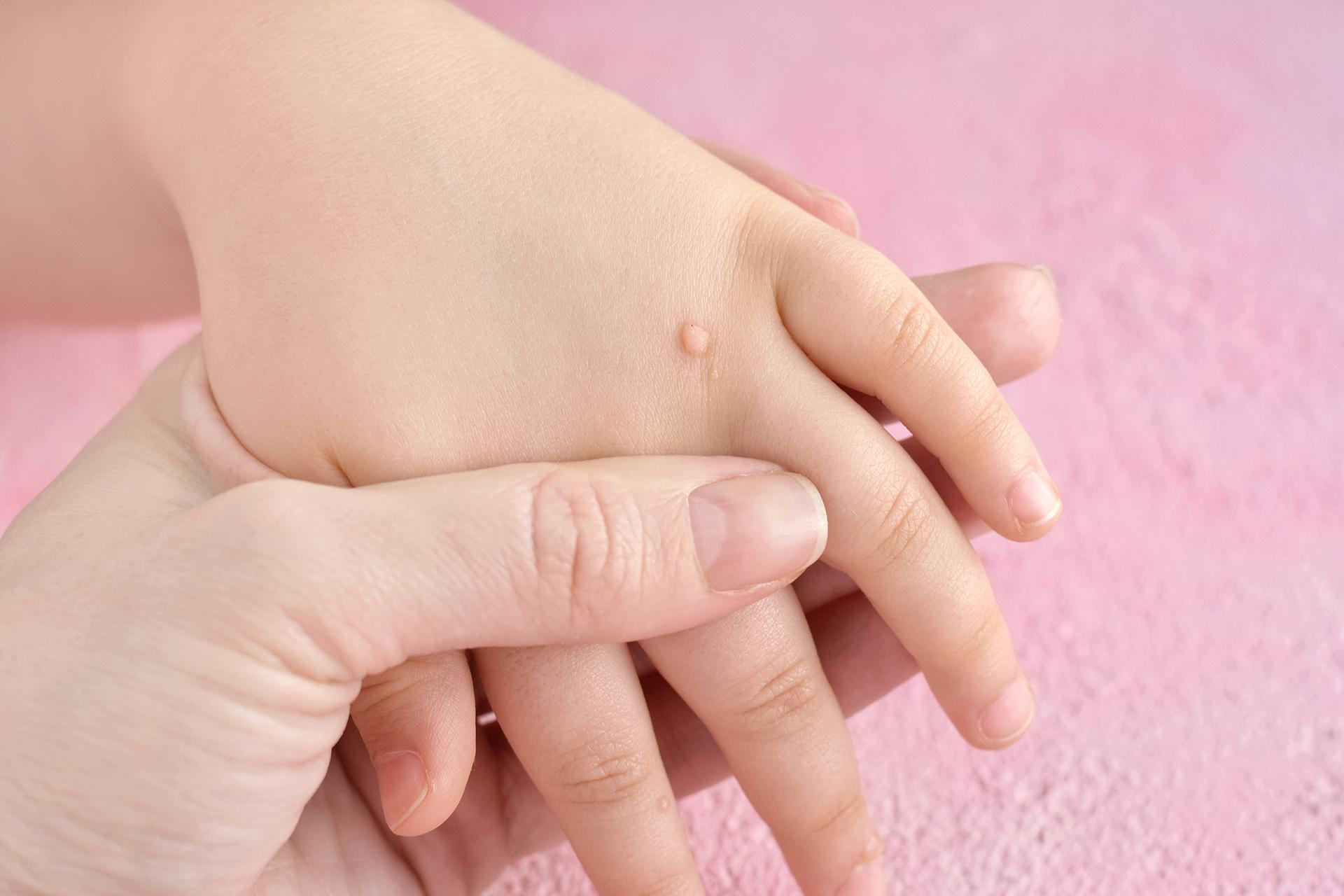 Warts Treatment: Top 4 Wart Removal Home Remedies To Try