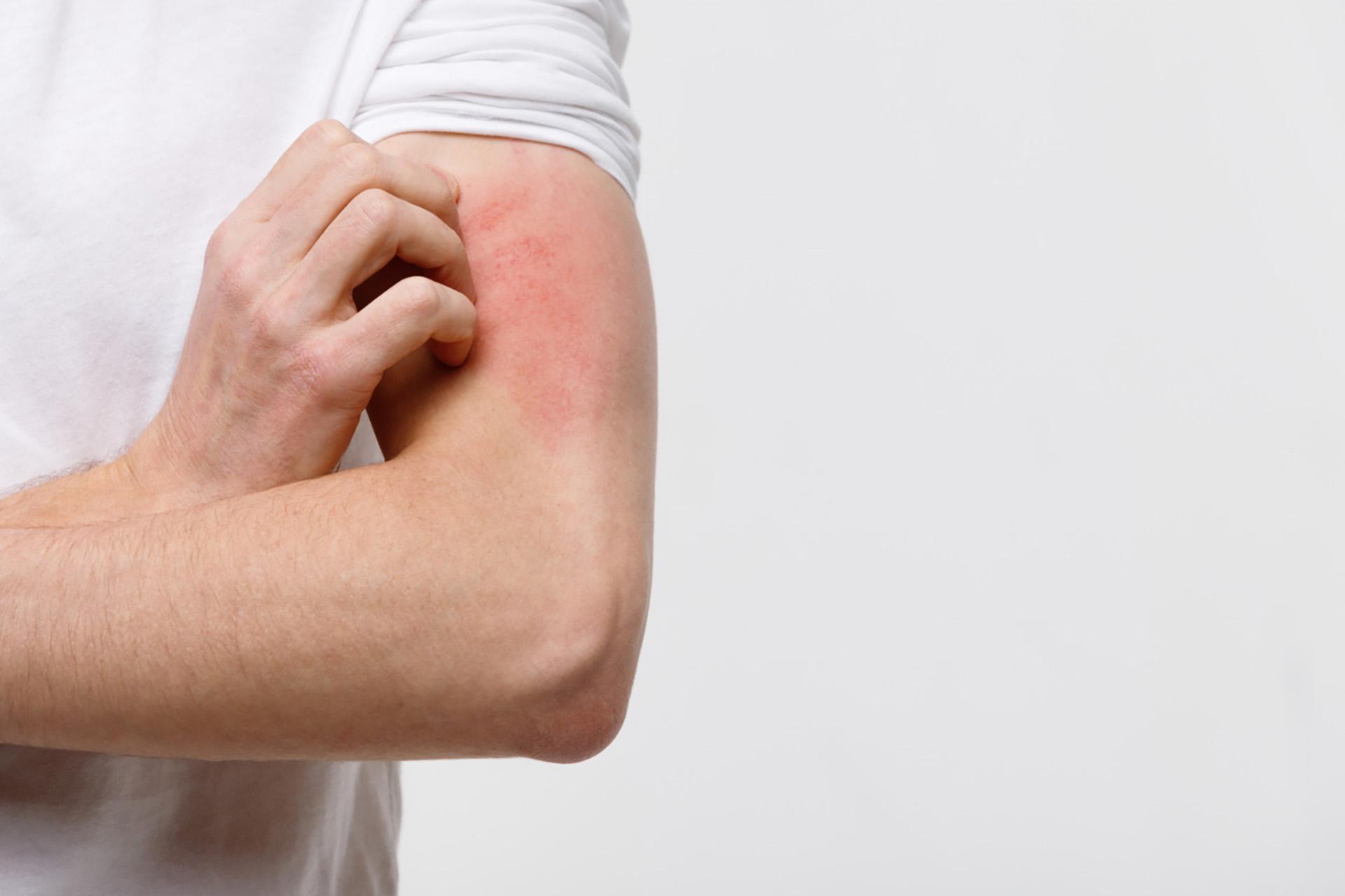 Staph Infection Treatment: 4 Key Things You Need to Know