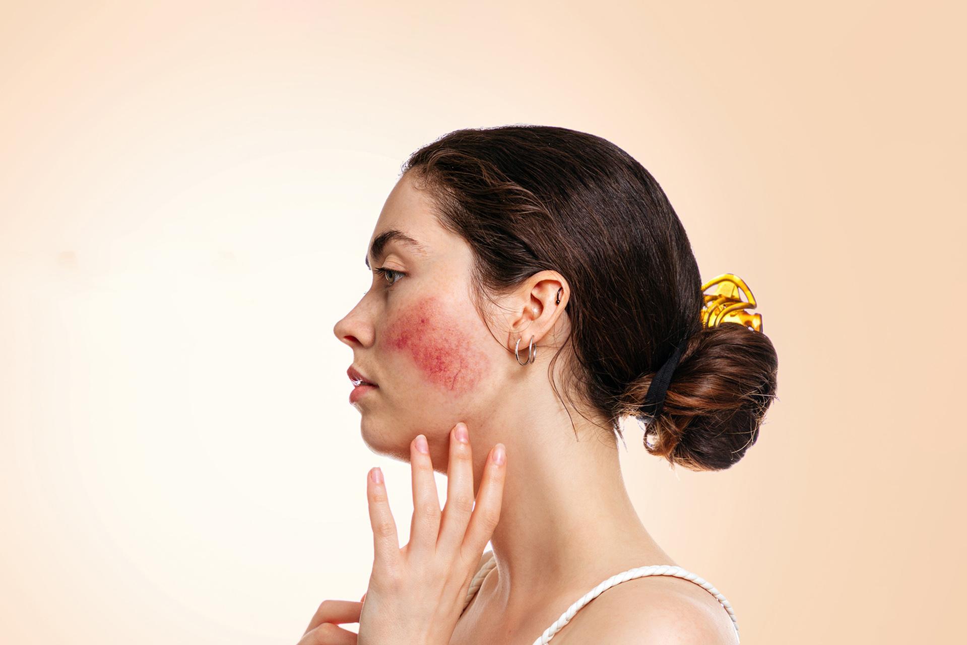 How Is Rosacea Diagnosed and Is Rosacea Treatment Effective? All You Should Know
