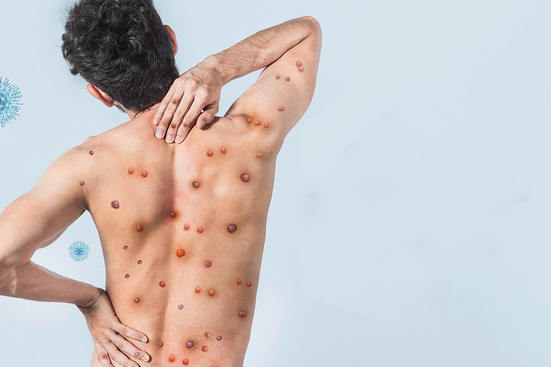 Know About Monkeypox: Symptoms, Causes, Treatment and Prevention