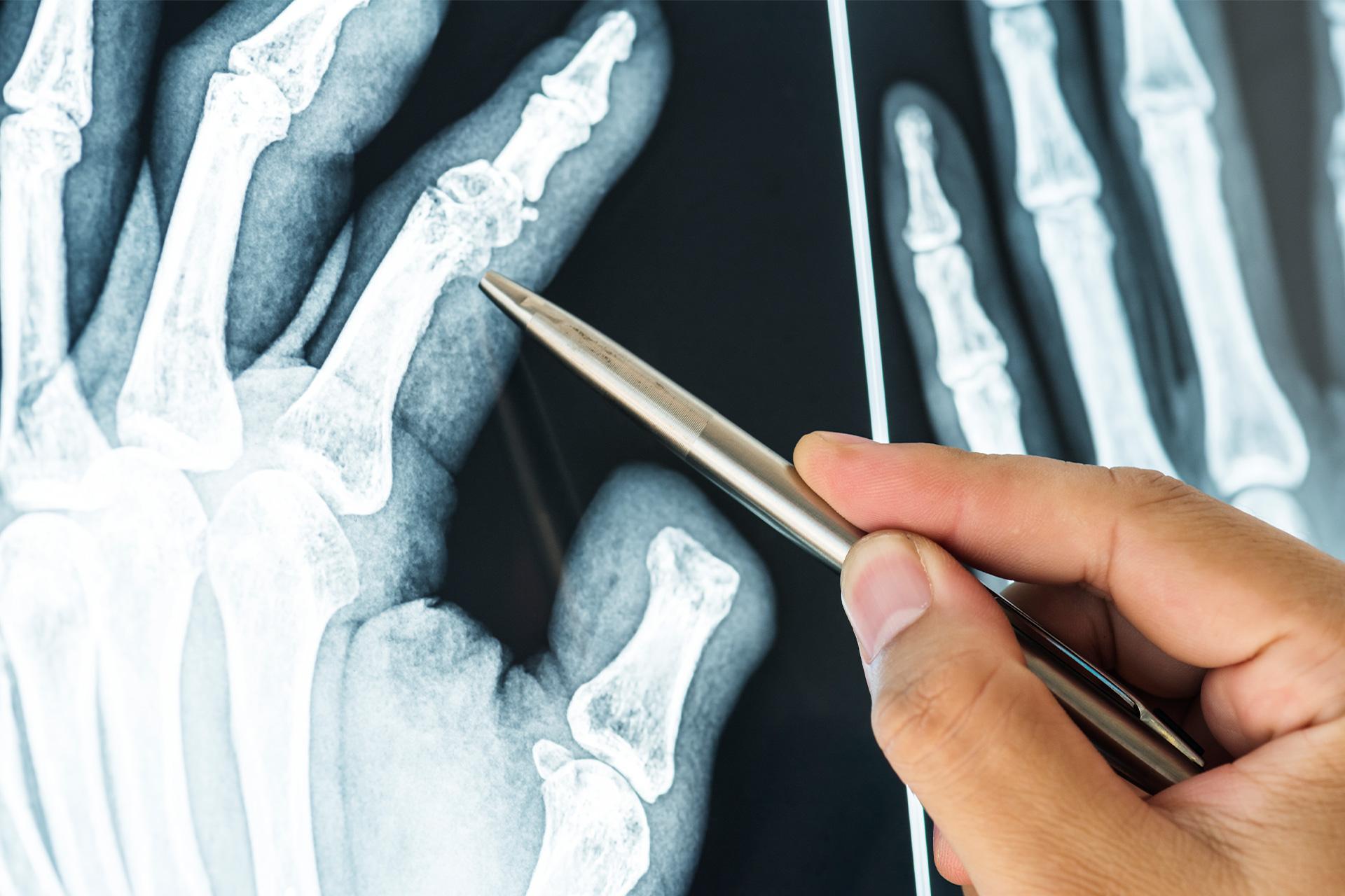 Fracture in Bones: Causes, Types, Symptoms and Treatment