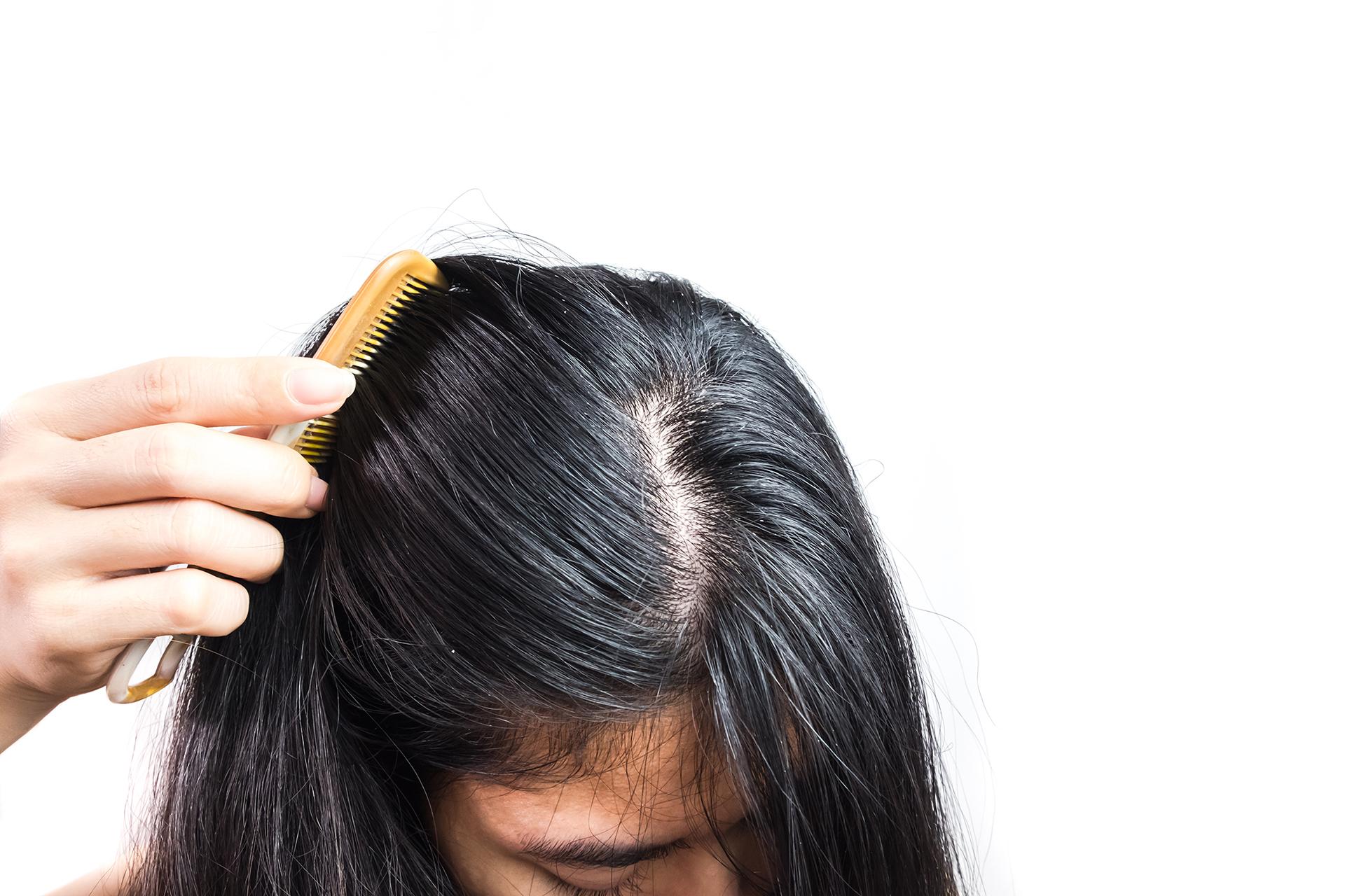 10 Greasy Hair Home Remedies That Benefit Your Scalp