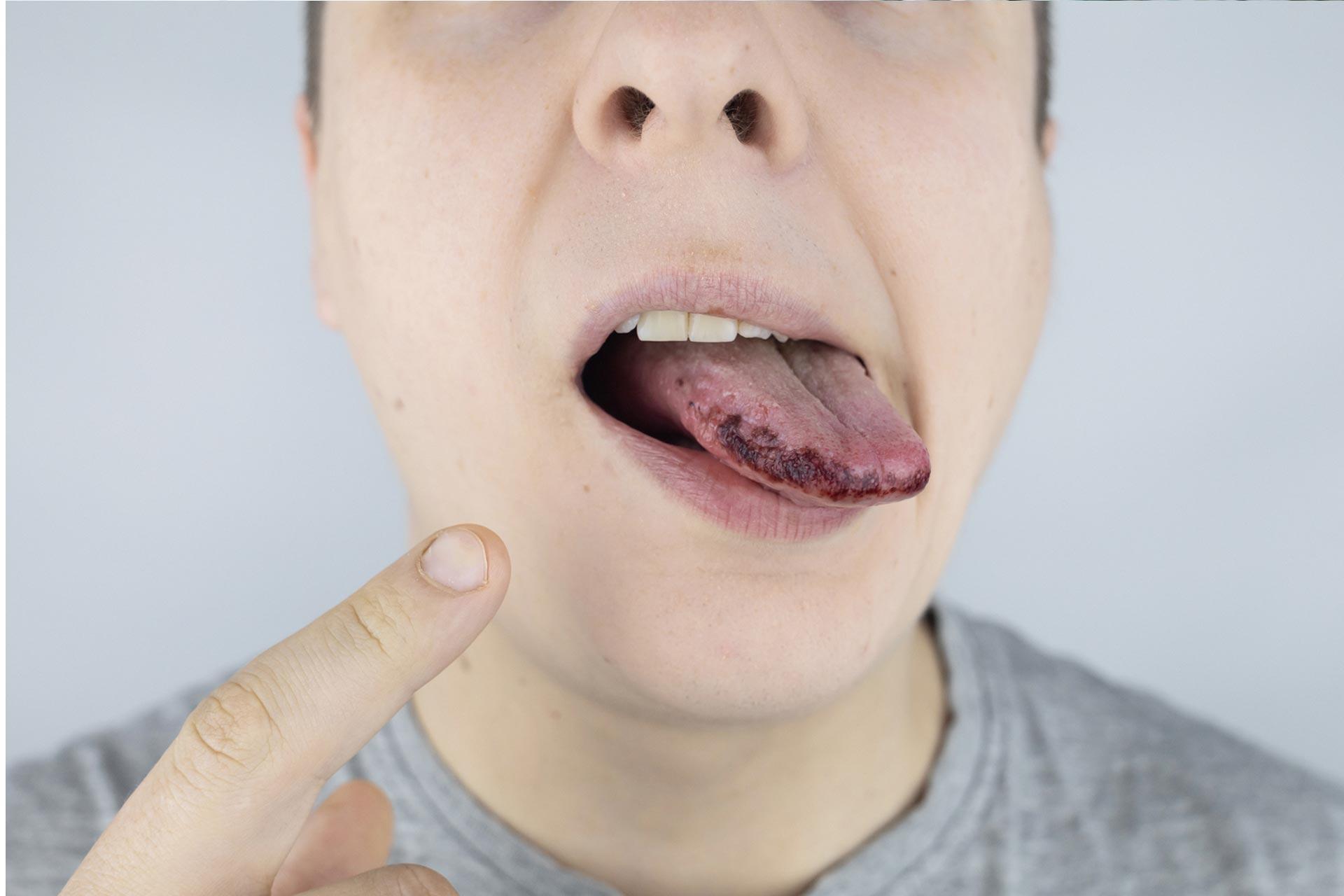 Black Spots on the Tongue: Causes, Symptoms, Diagnosis, and Treatment