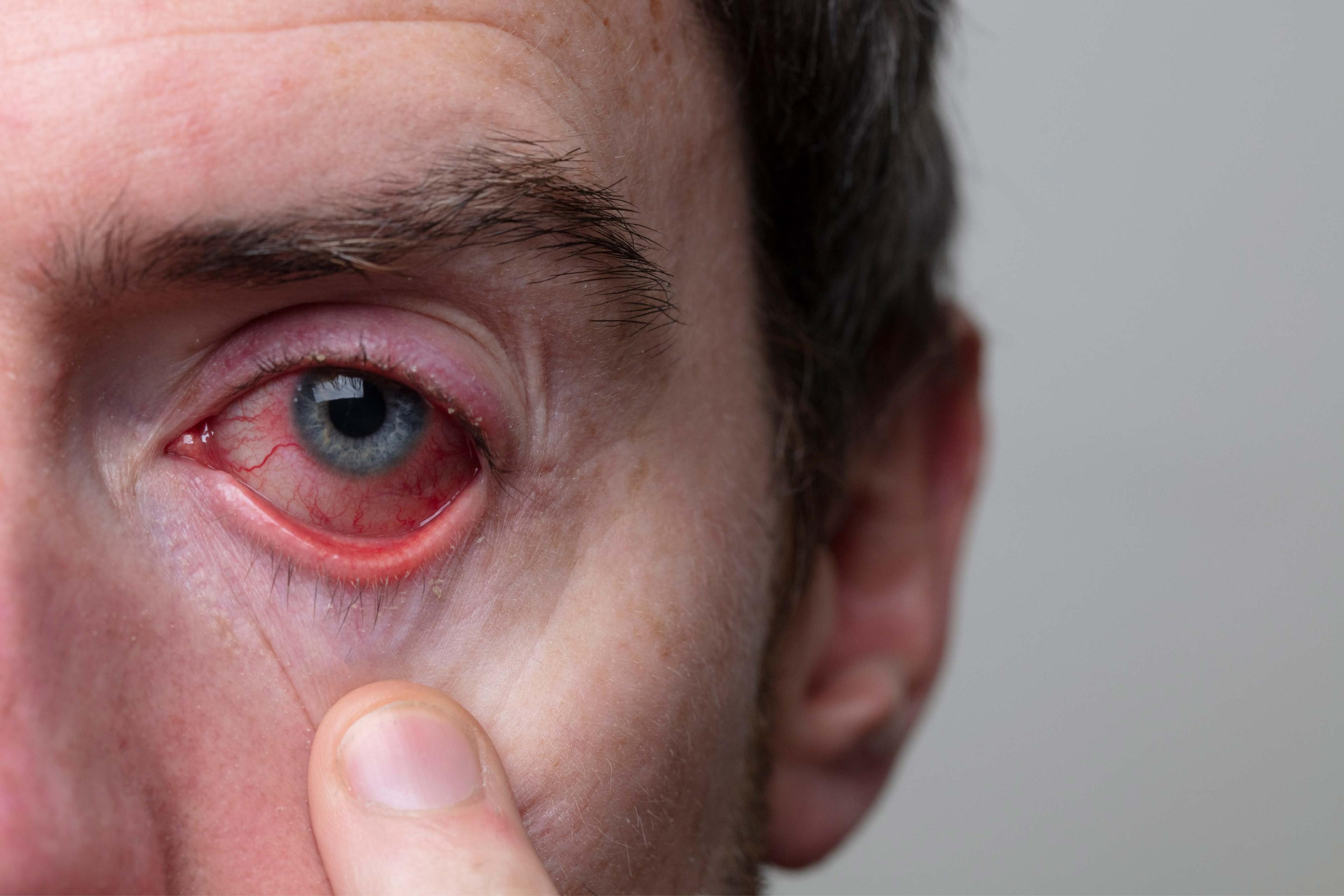 नेत्रश्लेष्मलाशोथ (गुलाबी आंखें): कारण, लक्षण और रोकथाम