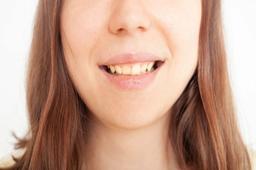 स्टेन्ड दातांची सामान्य कारणे आणि त्यांचे उपचार