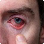 डोळ्यांच्या बुबुळाच्या पुढील भागाचा होणारा दाह (गुलाबी डोळे): कारणे, लक्षणे आणि प्रतिबंध