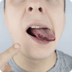 Black Spots on the Tongue: Causes, Symptoms, Diagnosis, and Treatment