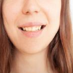 Common Reasons for Stained Teeth and their Treatments