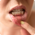 Oral Thrush: Causes, Symptoms, Prevention and Home Remedies