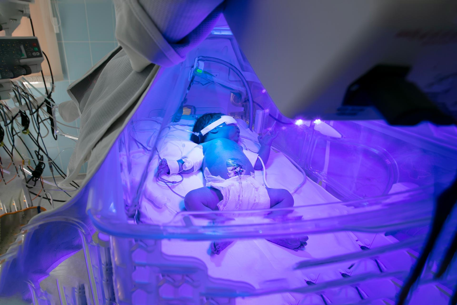 Newborn Jaundice: How to Take Care of Your Little Ones?