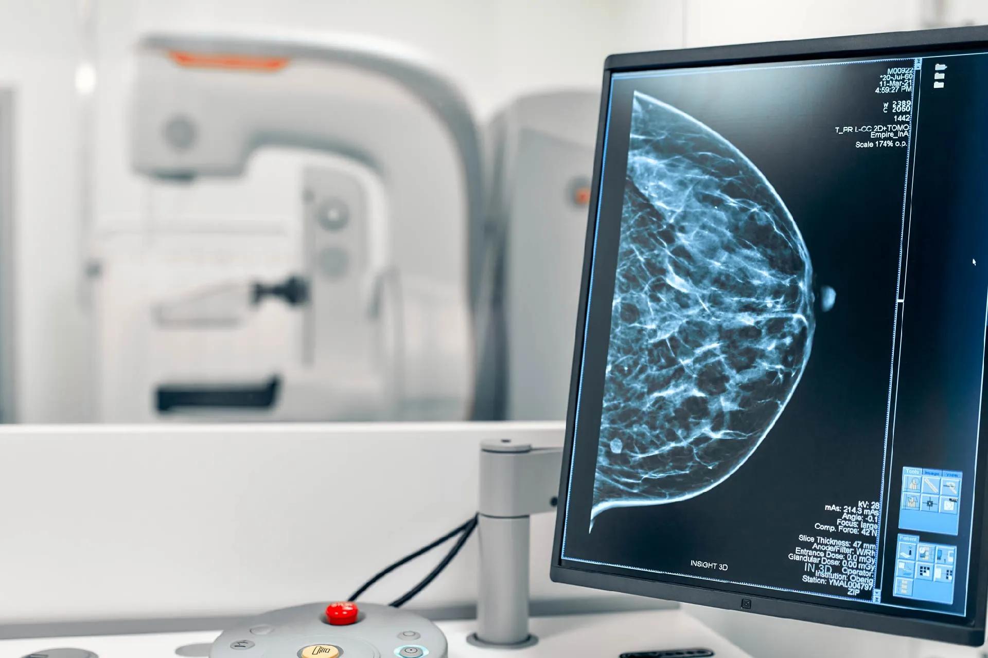 Everything you Need to Know About a Mammogram