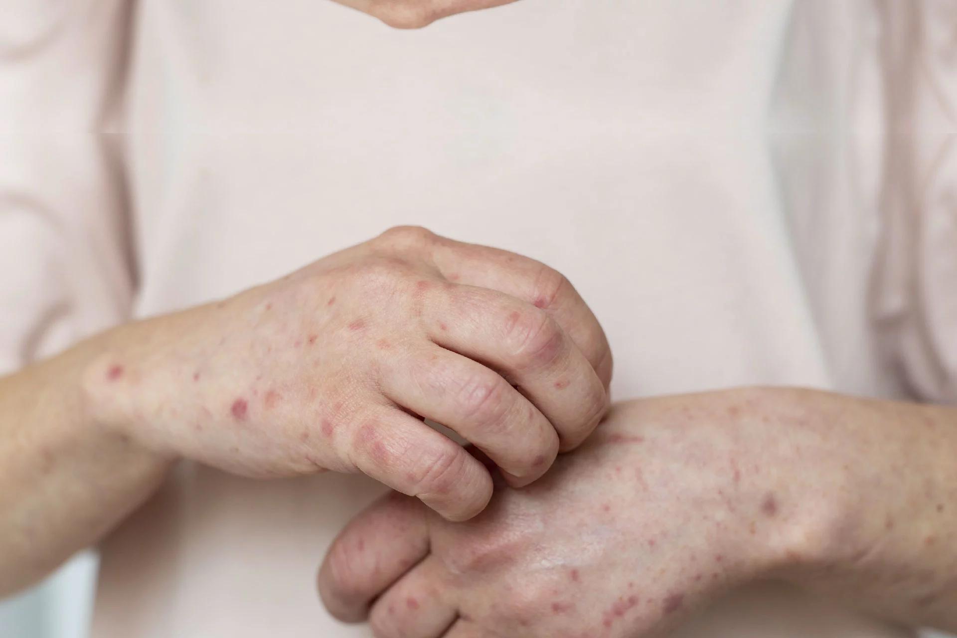 Seborrhoeic dermatitis: या स्थितीचे 6 प्रमुख पैलू