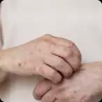 Seborrhoeic Dermatitis: 6 Salient Aspects of This Condition