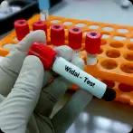 Widal Test Procedure, Normal Ranges, Price, Test Results