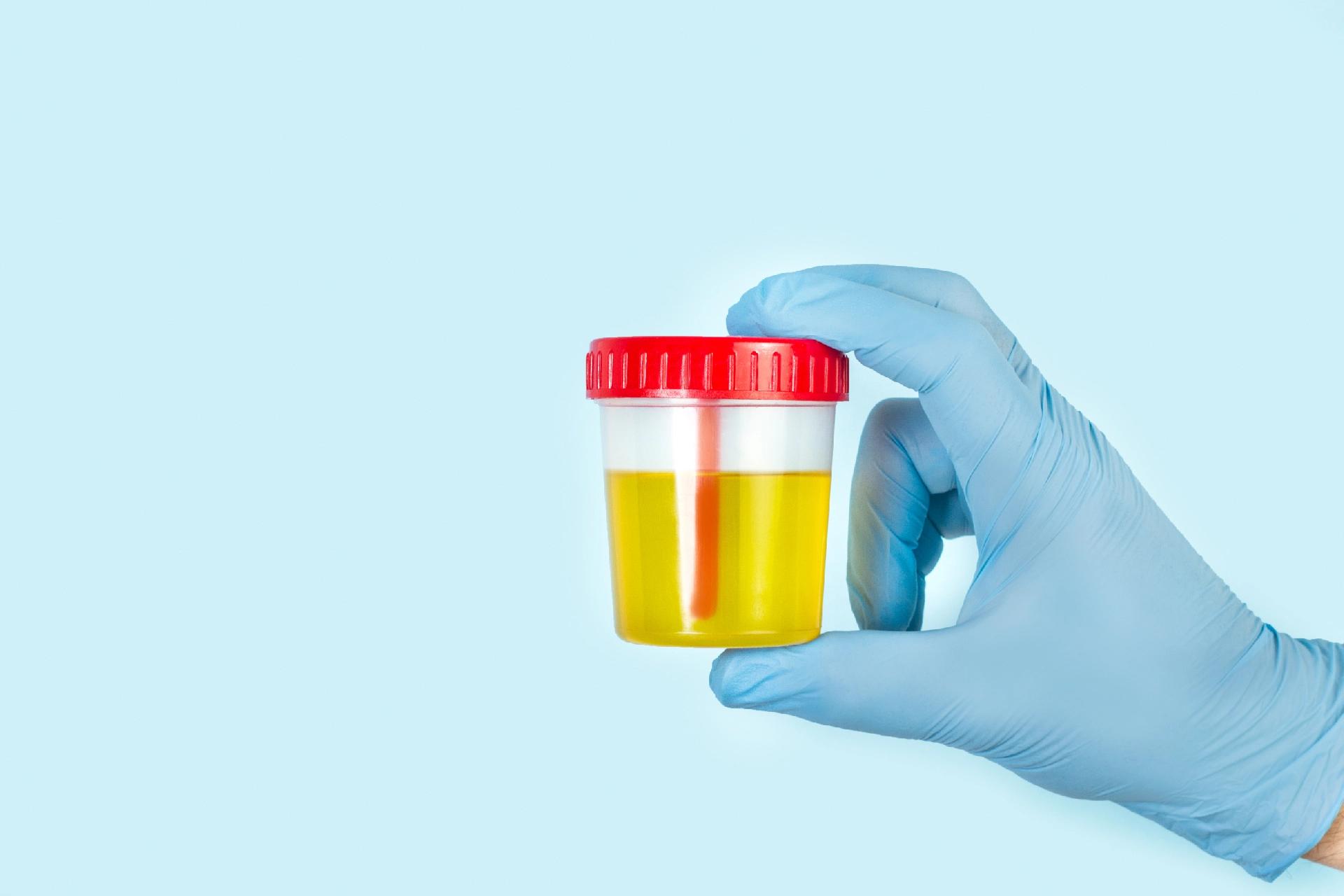 Blood in Urine: Reasons Behind and Ways to Cure It!