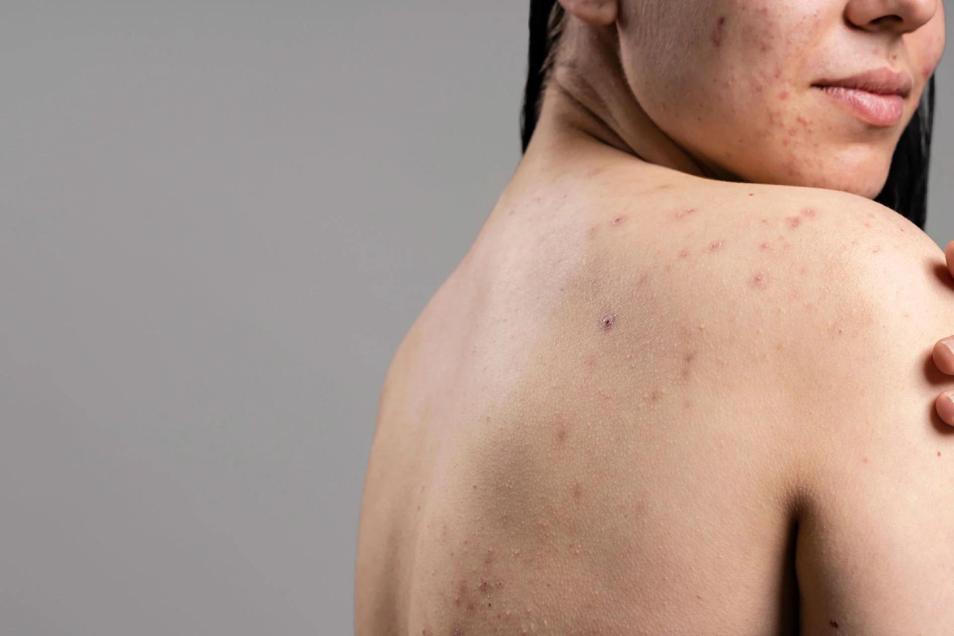 Back Acne: Early Symptoms, Prevention, Diagnosis, Type