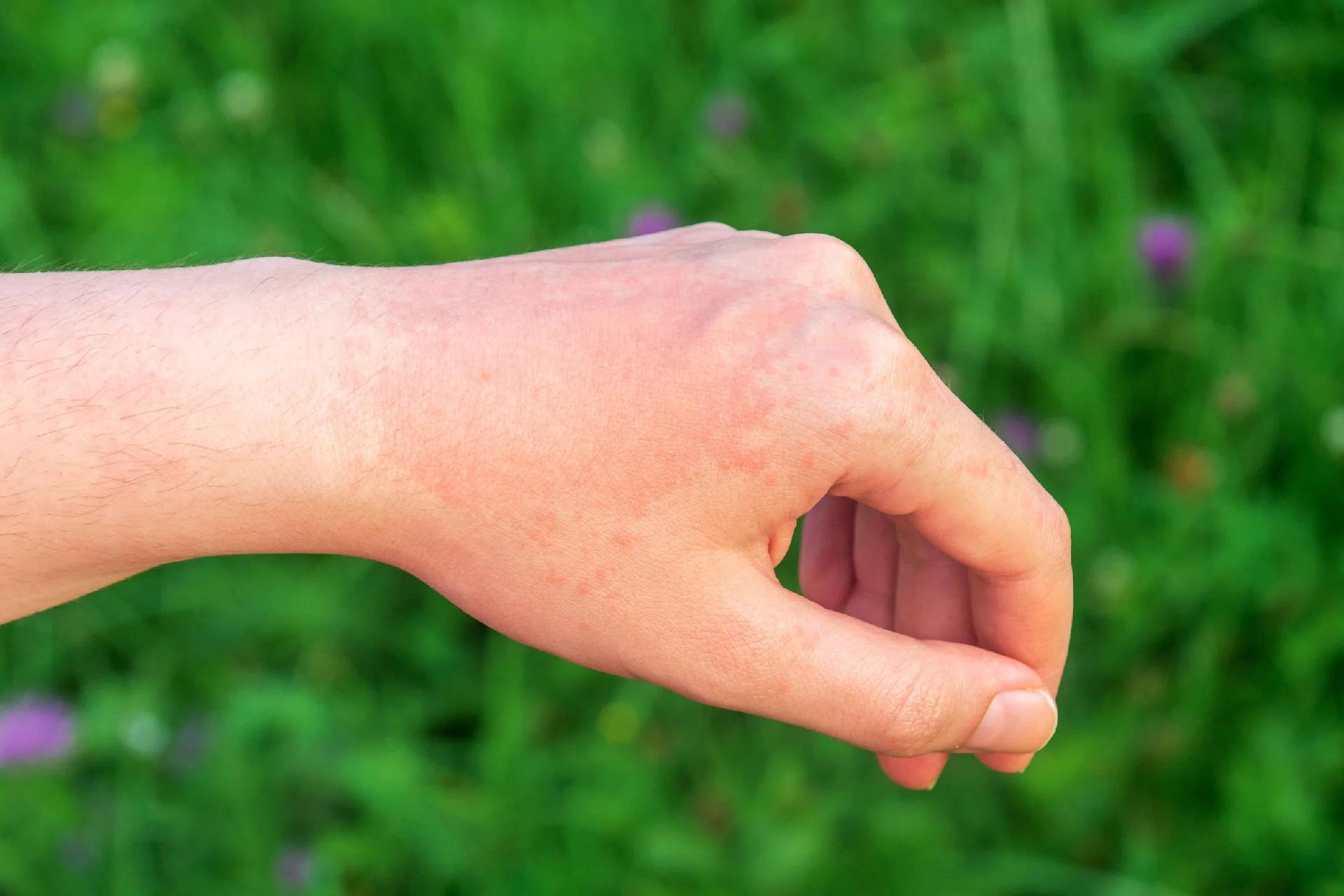 फंगल त्वचा संक्रमण: कारण, प्रारंभिक लक्षण, प्रकार और उपचार