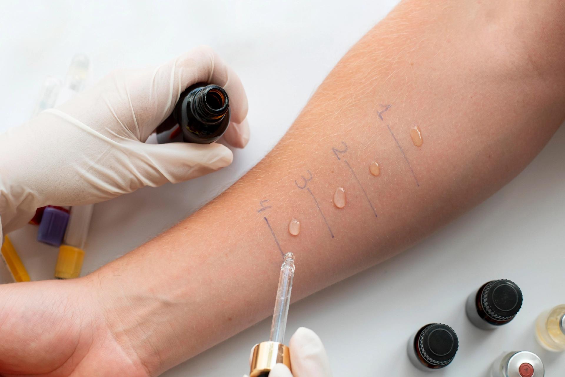 Allergy Testing: Types, Procedure and Common Allergens
